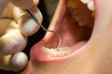 歯周病の治療(中等度)の場合